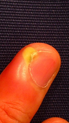 指の腫れ化膿